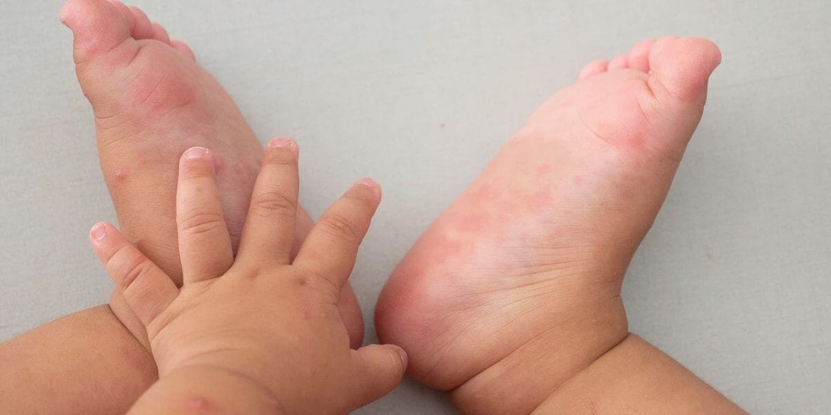 Hand Foot And Mouth Disease What It